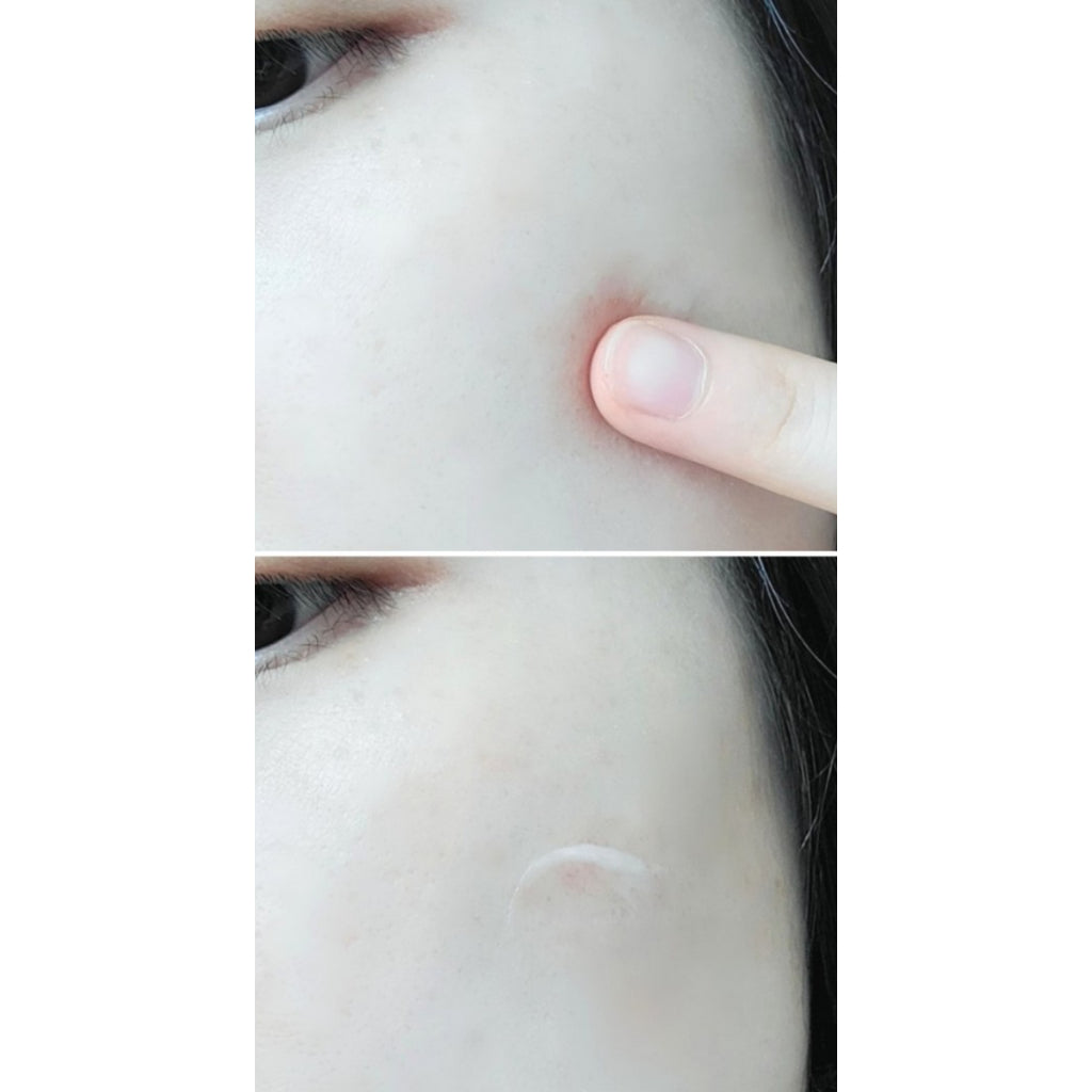 DONG-A Noscarna Gel 20g/pack Acne scars, Hypertrophic Keloid Scars, Surgical Scar Care / from Seoul, Korea