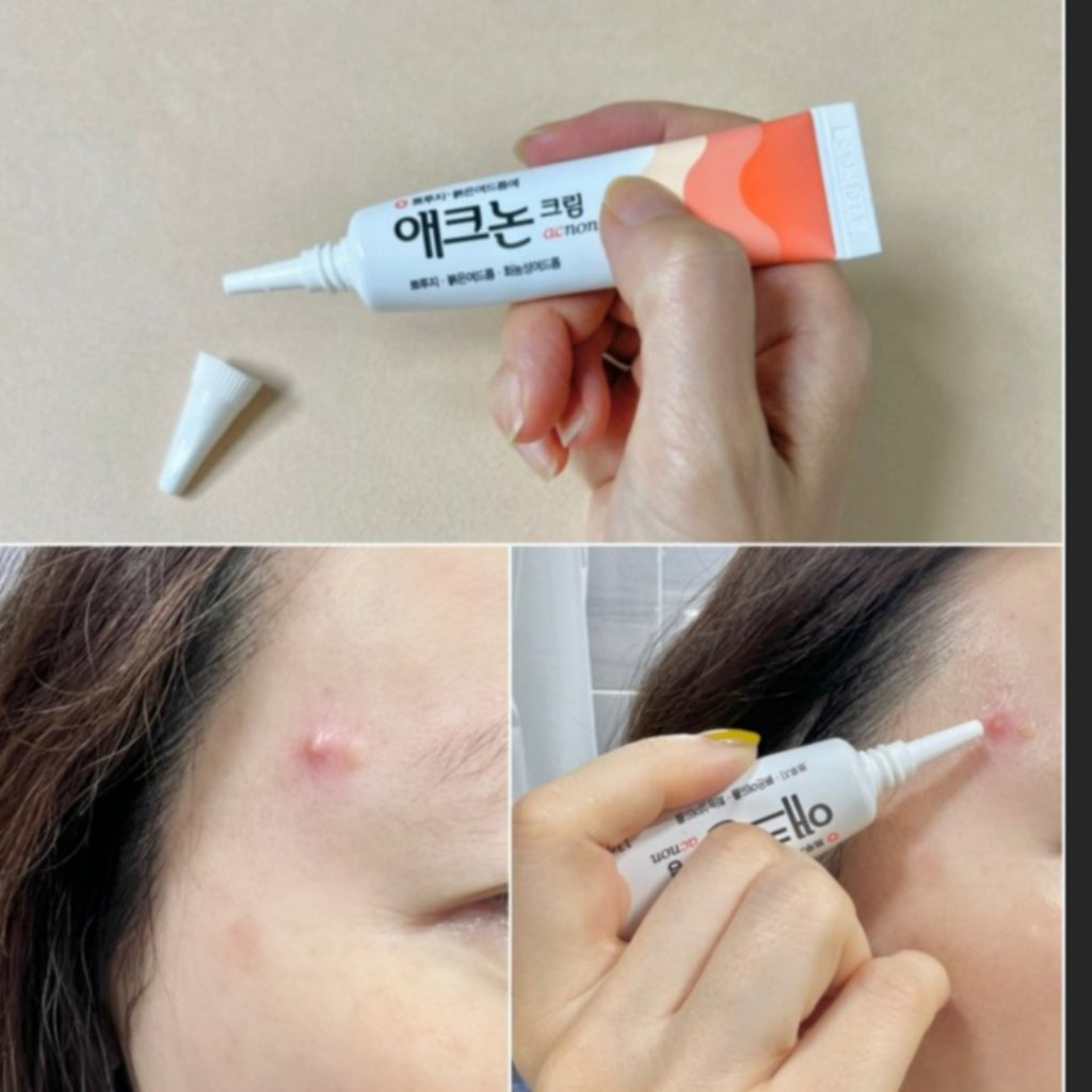 DONG-A Pharm. Acnon Cream 13g/pack Acne Care Treatment Pimples, Purulent Acne, No Antibiotics, No Steroids / from Seoul, Korea